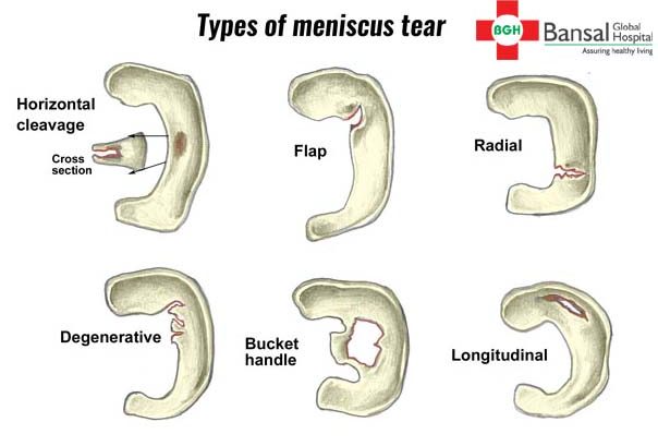 Meniscus-Tears