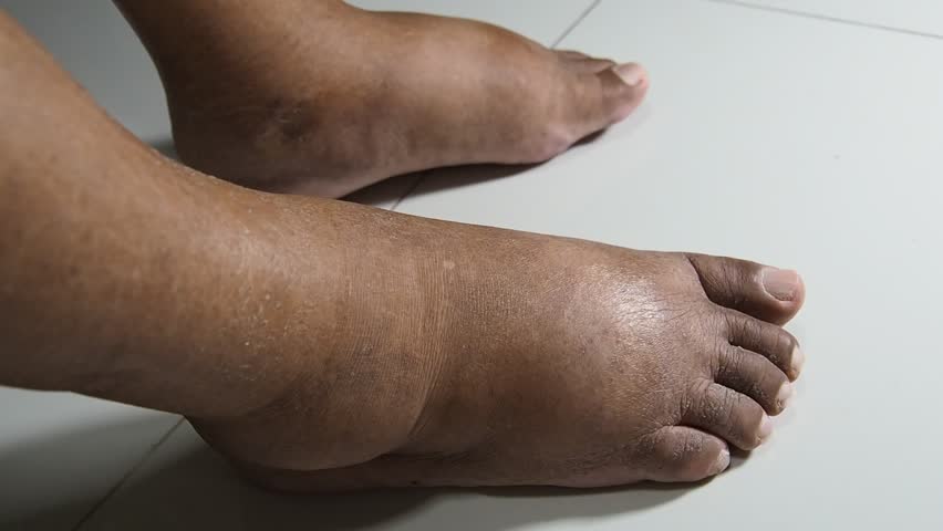 Why are My Feet Swollen?